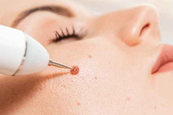 CryoPen: 5 Skin Concerns It May Be Used to Treat 3 What actually happens during a CryoPen treatment Prestwich?