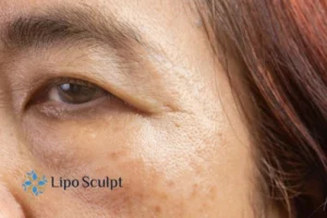 Cryopen: The Revolutionary Treatment for Age Spots Unveiled 2 Are age spots Prestwich giving you low self esteem? Contact us today!
