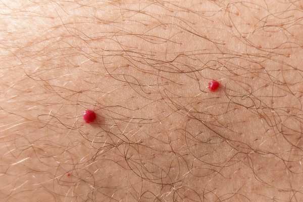 CryoPen: 5 Skin Concerns It May Be Used to Treat 2 cherry angioma removal Prestwich