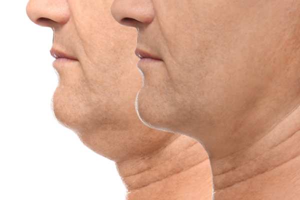 Book your Chin Reduction Treatment Prestwich today!