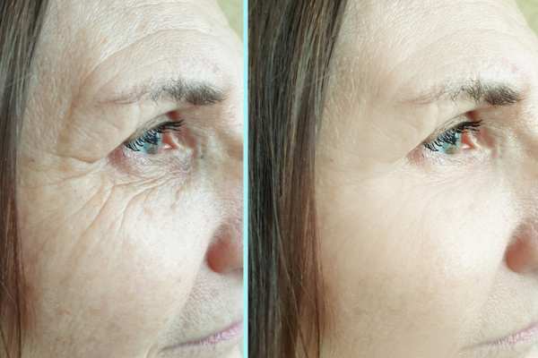 Why Do People Choose HIFU for a Non-Surgical Facelift? 4 How long can HIFU results last Prestwich?