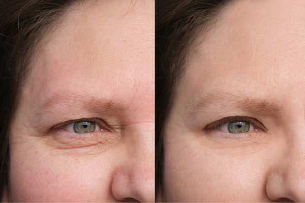 HIFU vs Botulinum Toxin: Understanding the Differences 4 How long do HIFU results last Prestwich?