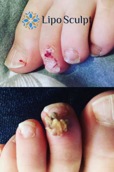 Wart removal customer results from Lipo Sculpt Prestwich