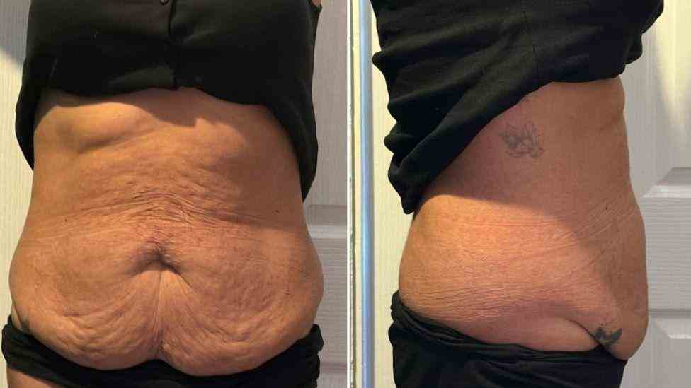 Lost the Weight but Not the Loose Skin? What You Should Know 1 Is It Definitely Loose Skin Prestwich?