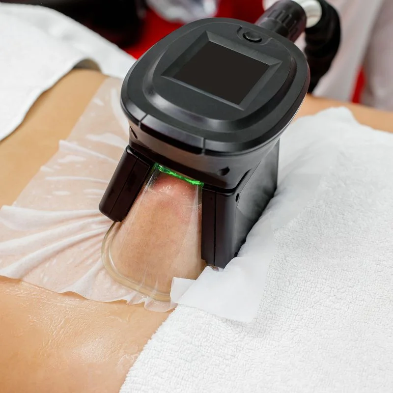 Fat Freezing treatment Prestwich